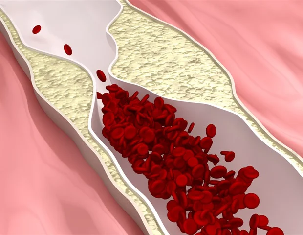 Unmet Challenge of Atherosclerosis Awareness