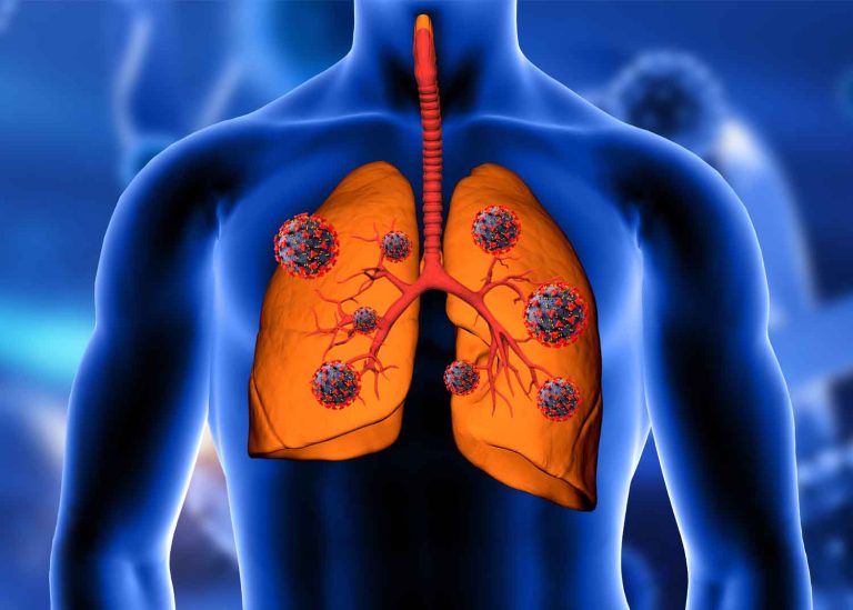 Revolutionizing World COPD Day: Addressing the Silent Epidemic of Chronic Lung Disease